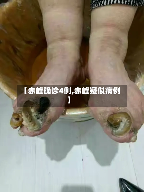 【赤峰确诊4例,赤峰疑似病例】