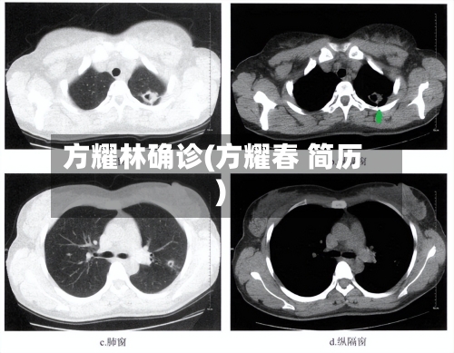 方耀林确诊(方耀春 简历)