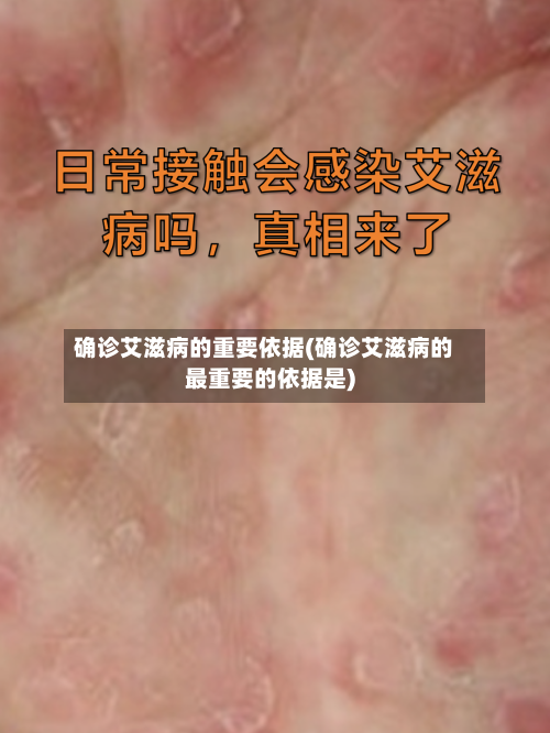 确诊艾滋病的重要依据(确诊艾滋病的最重要的依据是)-第2张图片