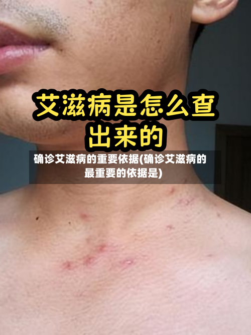 确诊艾滋病的重要依据(确诊艾滋病的最重要的依据是)
