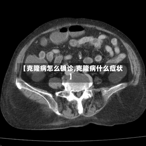 【克隆病怎么确诊,克隆病什么症状】-第3张图片