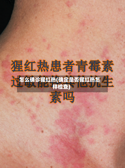 怎么确诊猩红热(确定是否猩红热怎样检查)