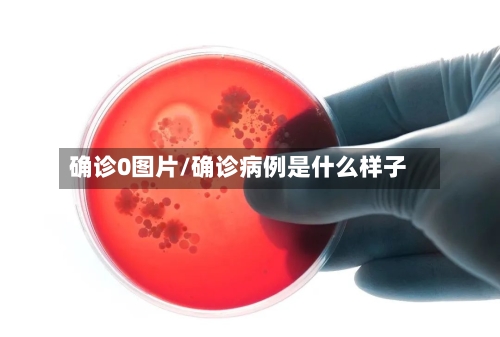 确诊0图片/确诊病例是什么样子-第2张图片