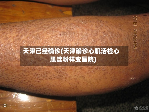 天津已经确诊(天津确诊心肌活检心肌淀粉样变医院)-第2张图片