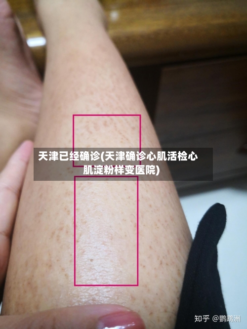 天津已经确诊(天津确诊心肌活检心肌淀粉样变医院)-第3张图片