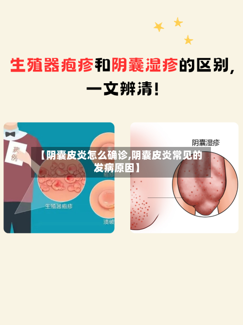 【阴囊皮炎怎么确诊,阴囊皮炎常见的发病原因】-第3张图片