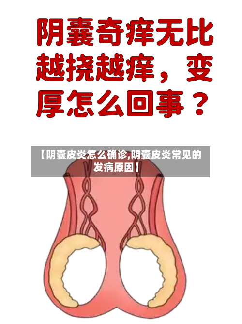 【阴囊皮炎怎么确诊,阴囊皮炎常见的发病原因】-第2张图片