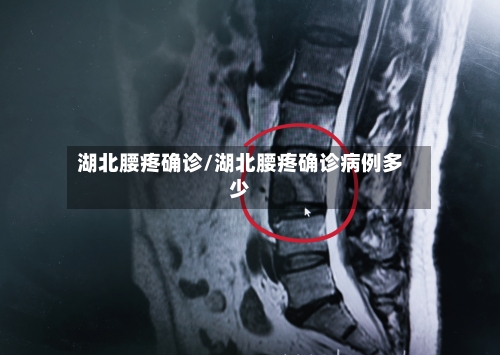 湖北腰疼确诊/湖北腰疼确诊病例多少