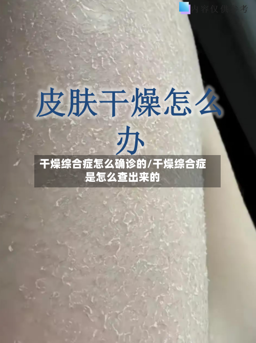 干燥综合症怎么确诊的/干燥综合症是怎么查出来的