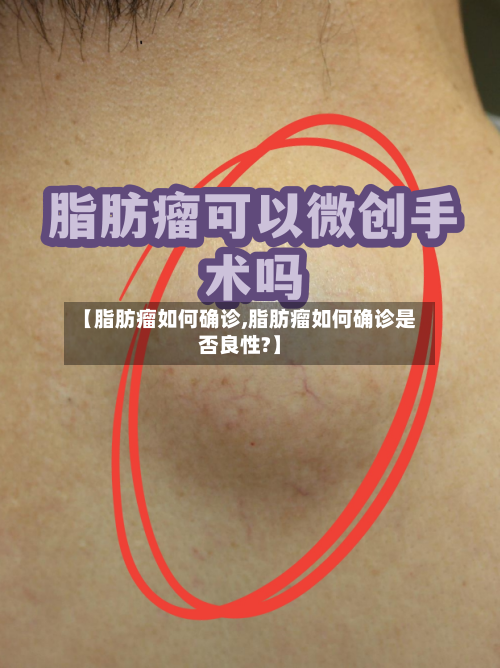 【脂肪瘤如何确诊,脂肪瘤如何确诊是否良性?】-第2张图片