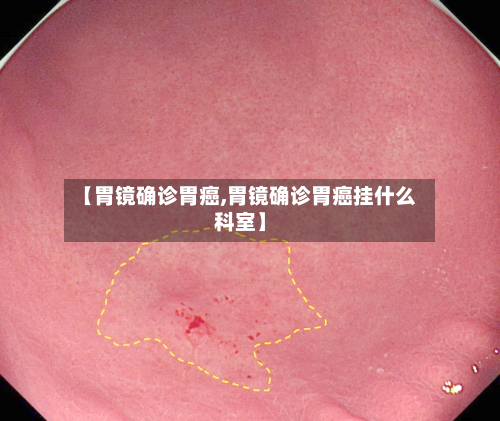 【胃镜确诊胃癌,胃镜确诊胃癌挂什么科室】