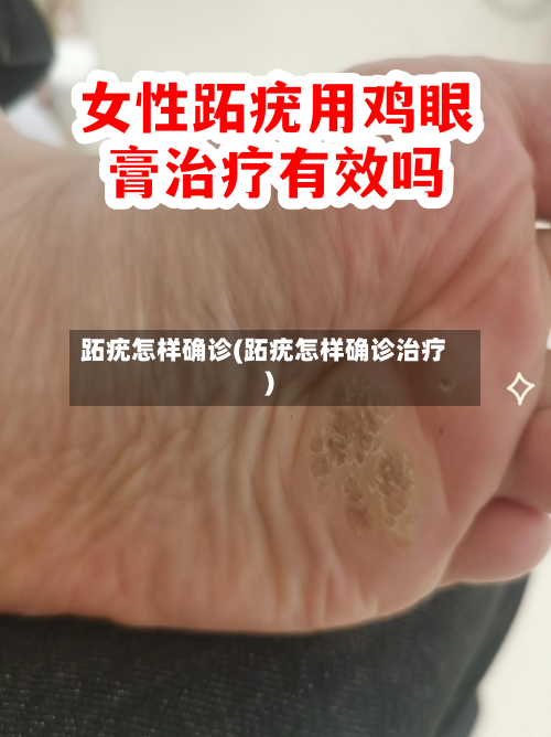 跖疣怎样确诊(跖疣怎样确诊治疗)-第2张图片