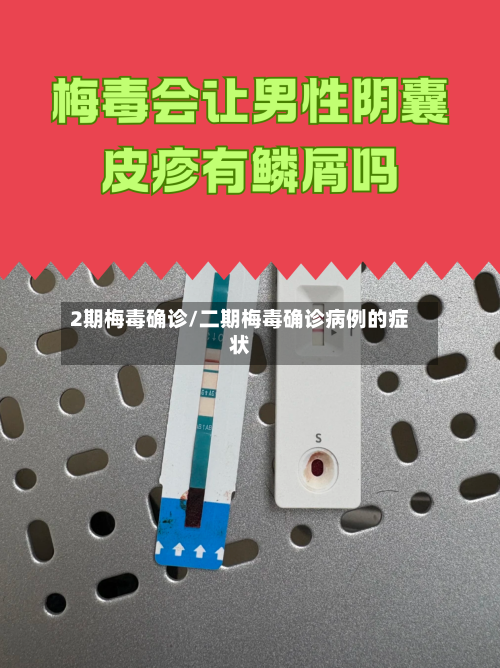 2期梅毒确诊/二期梅毒确诊病例的症状-第2张图片