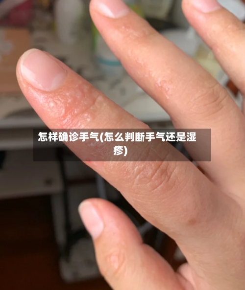 怎样确诊手气(怎么判断手气还是湿疹)-第2张图片