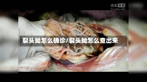 裂头蚴怎么确诊/裂头蚴怎么查出来-第2张图片