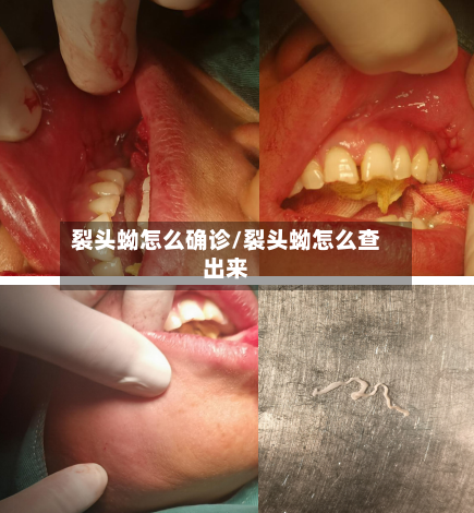 裂头蚴怎么确诊/裂头蚴怎么查出来-第3张图片