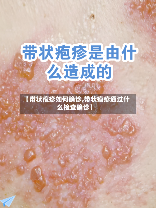 【带状疱疹如何确诊,带状疱疹通过什么检查确诊】