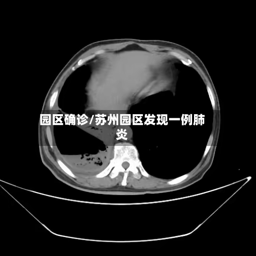 园区确诊/苏州园区发现一例肺炎