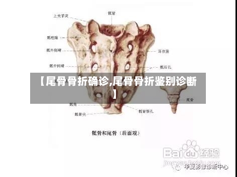 【尾骨骨折确诊,尾骨骨折鉴别诊断】