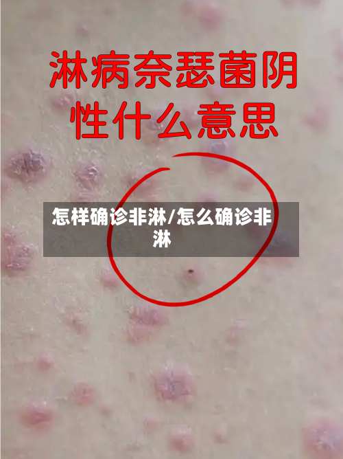 怎样确诊非淋/怎么确诊非淋