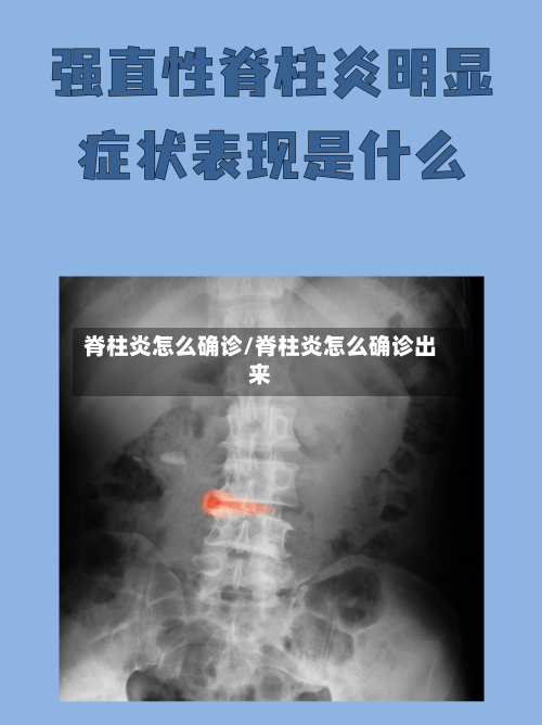 脊柱炎怎么确诊/脊柱炎怎么确诊出来-第2张图片