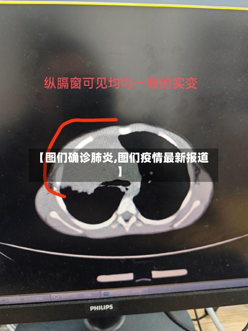【图们确诊肺炎,图们疫情最新报道】-第3张图片