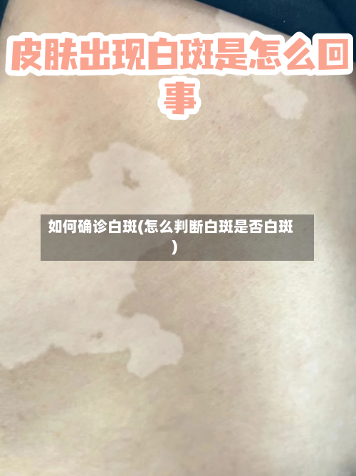 如何确诊白斑(怎么判断白斑是否白斑)-第2张图片