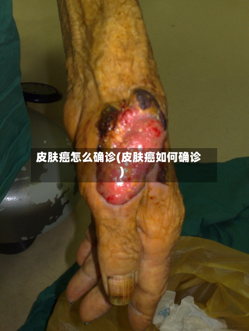 皮肤癌怎么确诊(皮肤癌如何确诊)