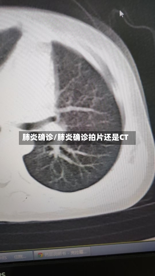 肺炎确诊/肺炎确诊拍片还是CT-第3张图片