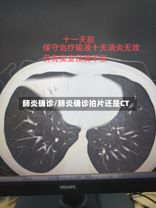 肺炎确诊/肺炎确诊拍片还是CT