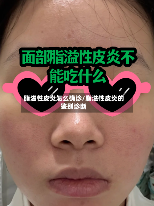脂溢性皮炎怎么确诊/脂溢性皮炎的鉴别诊断