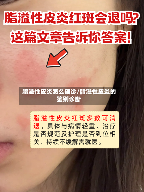 脂溢性皮炎怎么确诊/脂溢性皮炎的鉴别诊断-第2张图片