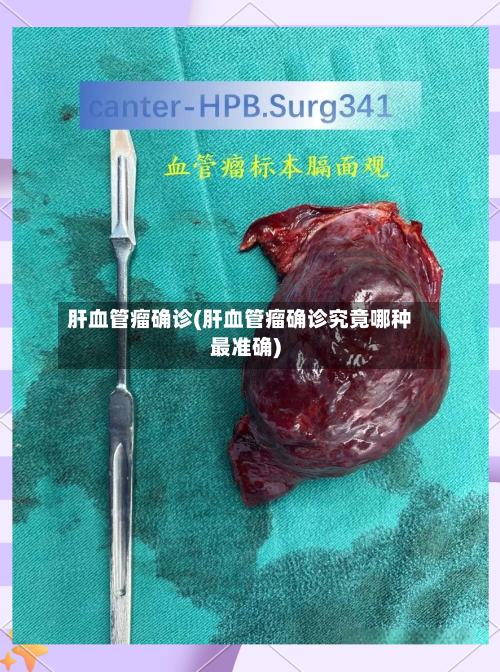肝血管瘤确诊(肝血管瘤确诊究竟哪种最准确)