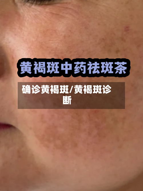 确诊黄褐斑/黄褐斑诊断