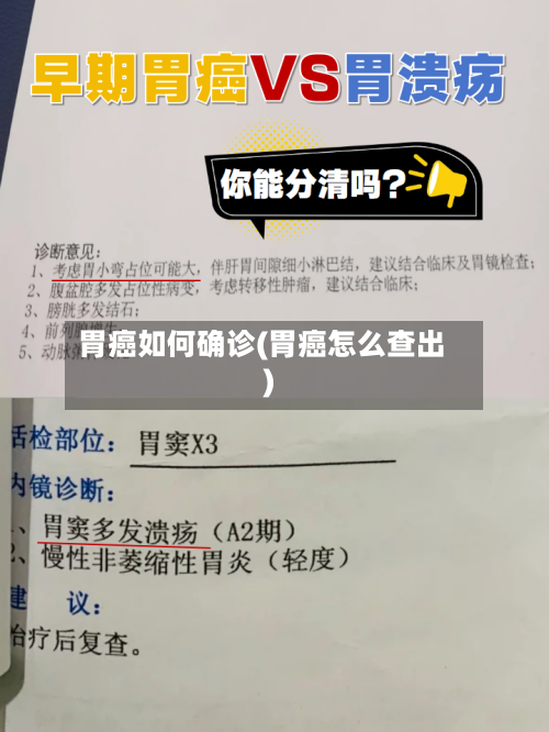 胃癌如何确诊(胃癌怎么查出)