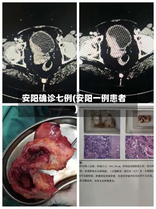 安阳确诊七例(安阳一例患者)