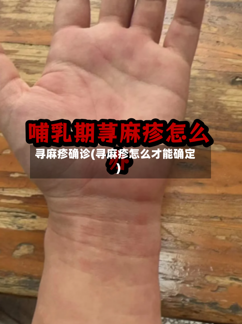 寻麻疹确诊(寻麻疹怎么才能确定)