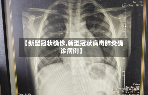 【新型冠状确诊,新型冠状病毒肺炎确诊病例】-第3张图片