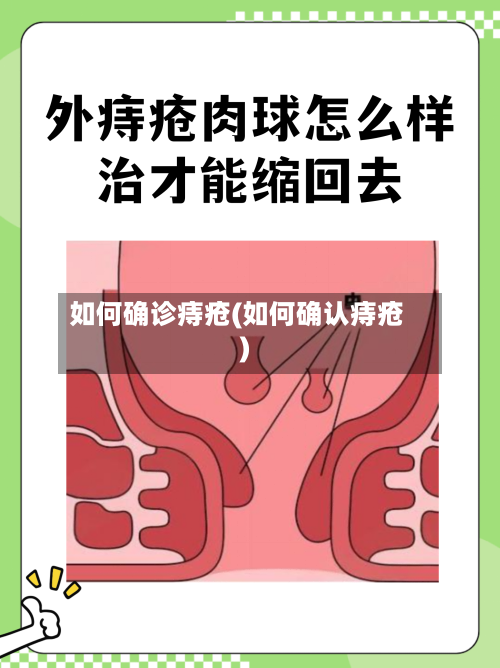 如何确诊痔疮(如何确认痔疮)