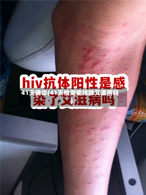 41天确诊(41天检测能排除艾滋病吗)