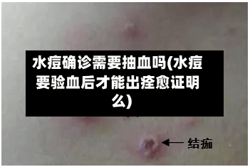 水痘确诊需要抽血吗(水痘要验血后才能出痊愈证明么)