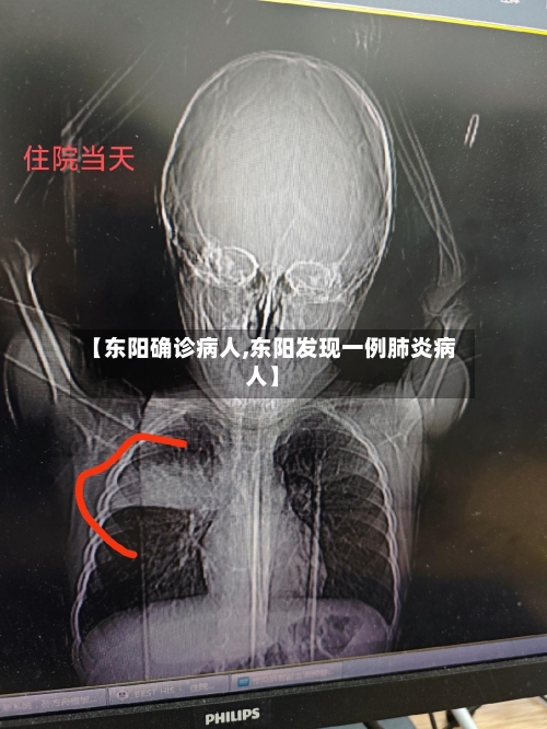 【东阳确诊病人,东阳发现一例肺炎病人】-第2张图片