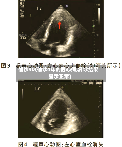 确诊40(确诊4年的冠心病,复诊结果显示正常)