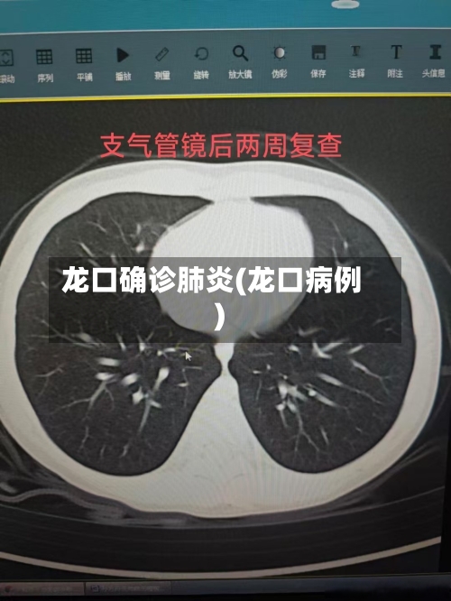 龙口确诊肺炎(龙口病例)-第2张图片