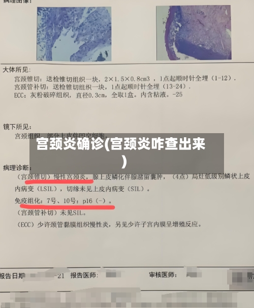 宫颈炎确诊(宫颈炎咋查出来)-第2张图片