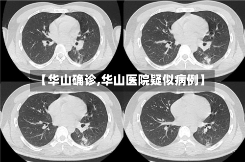 【华山确诊,华山医院疑似病例】-第3张图片
