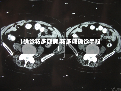 【确诊粘多糖病,粘多糖确诊手段】