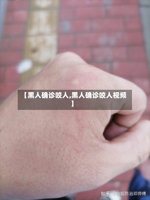 【黑人确诊咬人,黑人确诊咬人视频】-第3张图片