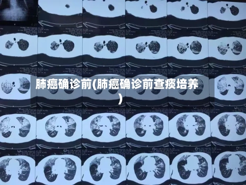 肺癌确诊前(肺癌确诊前查痰培养)-第3张图片