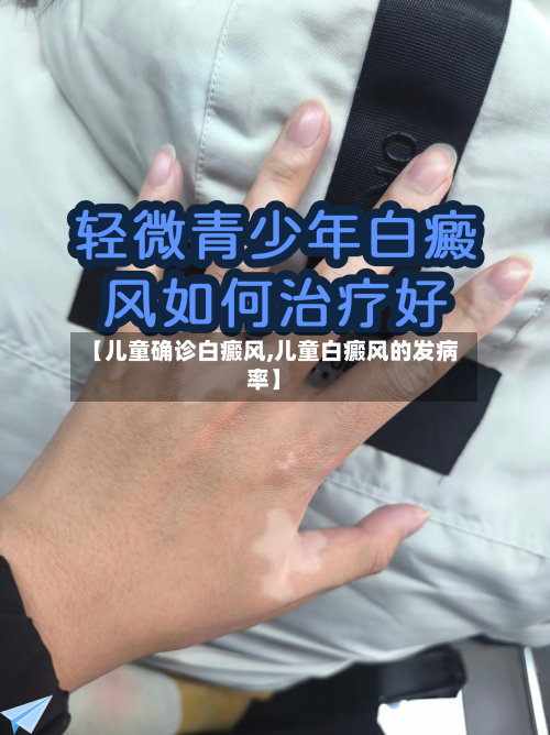 【儿童确诊白癜风,儿童白癜风的发病率】-第3张图片